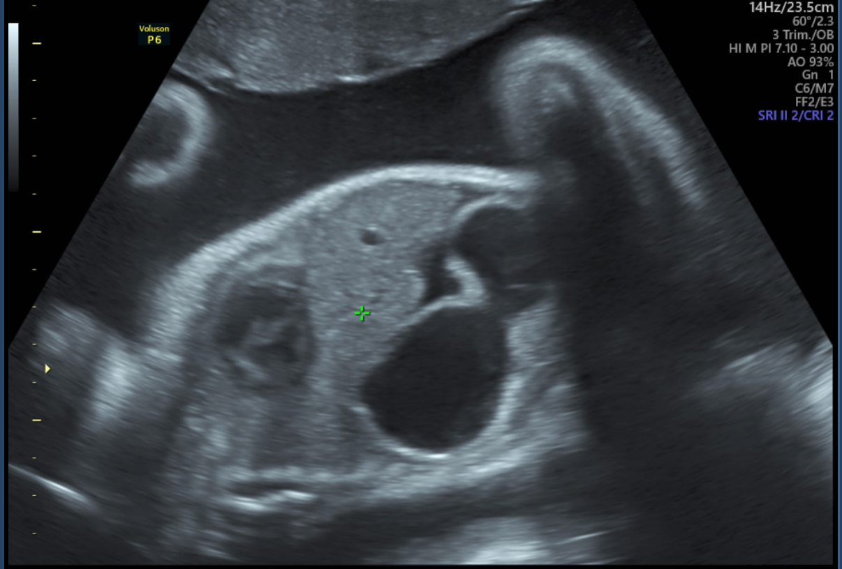 Imani NICU 3