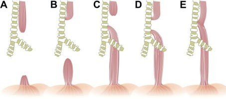 Types of Esophageal Atresia